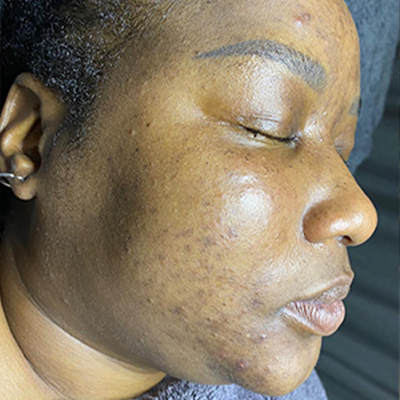 A Face picture of a woman with acne ready to start a treatment at monni skincare