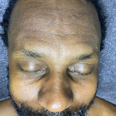 a man getting an Anti-aging treatment from monni skincare in midrand