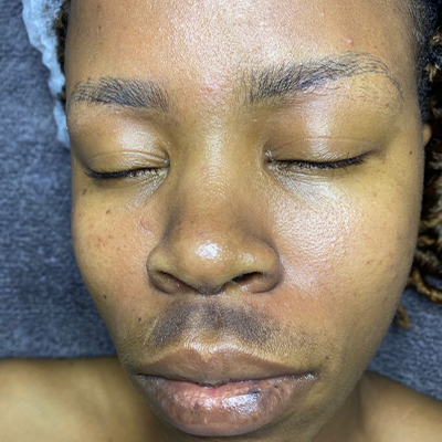 A Face picture of a lady with pigmentation ready to get a treatment from monni skincare in midrand